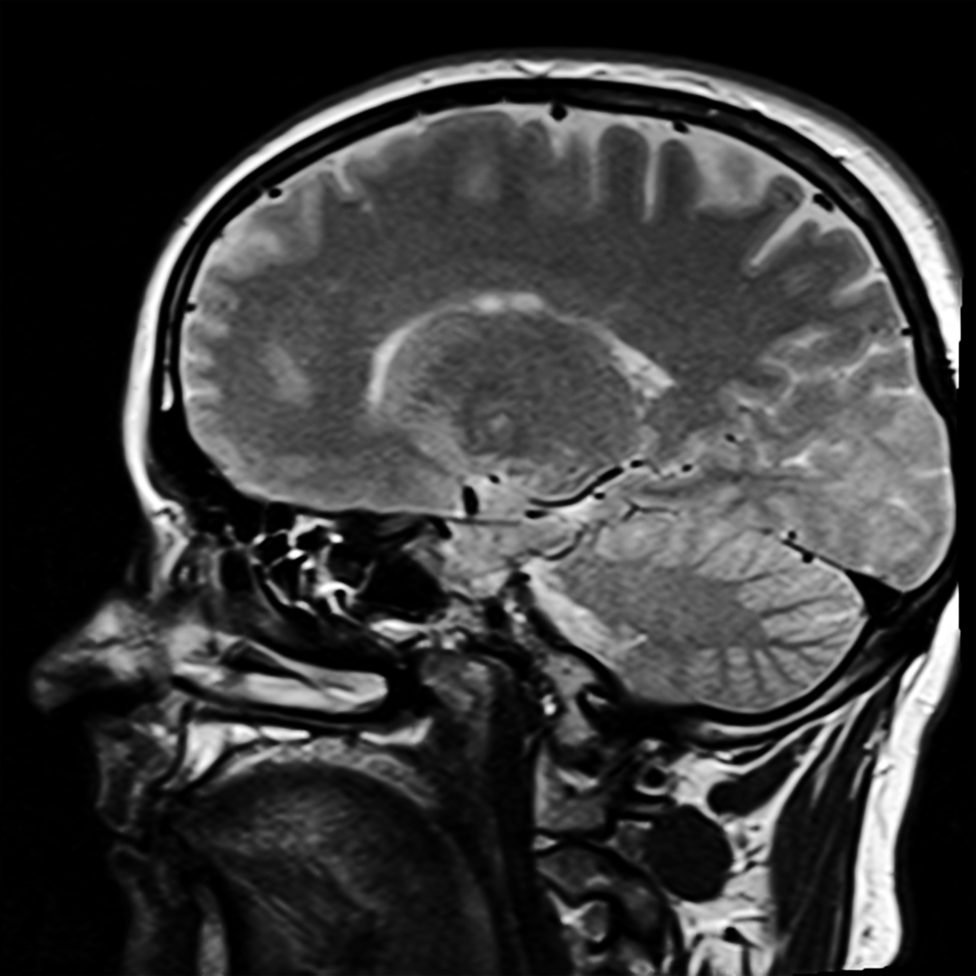 MRI-bilde av en hodeskalle